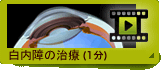 白内障の治療 (1分)